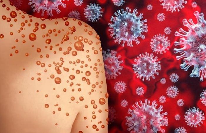 نيويورك "تفزع العالم".. أمريكا تعلن عن أول إصابة بـ"جُدري القرود" 3 نيويورك "تفزع العالم".. أمريكا تعلن عن أول إصابة بـ"جُدري القرود"