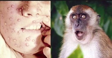 وزارة الصحة فى نيويورك: تأكيد أول إصابة بسلالة جديدة من فيروس جدرى القرود 4 وزارة الصحة فى نيويورك: تأكيد أول إصابة بسلالة جديدة من فيروس جدرى القرود